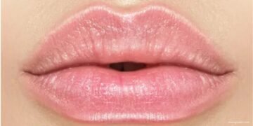 Lip Flip Before and After